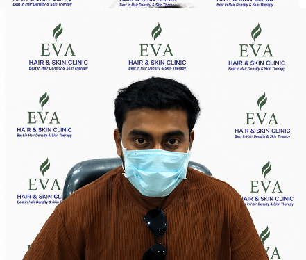 After hair transplant result 6